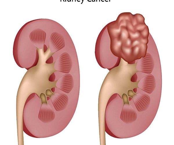 راه های پیشگیری و درمان سرطان کلیه